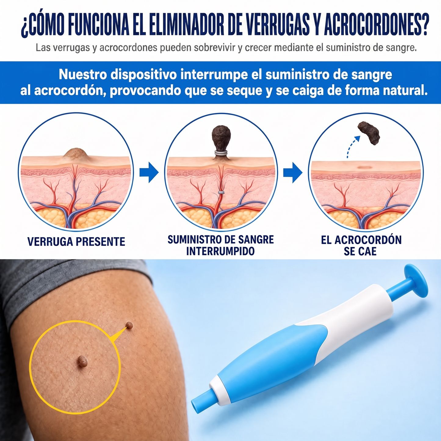 Kit Dervalon™ Removedor de Verrugas y Acrocordones