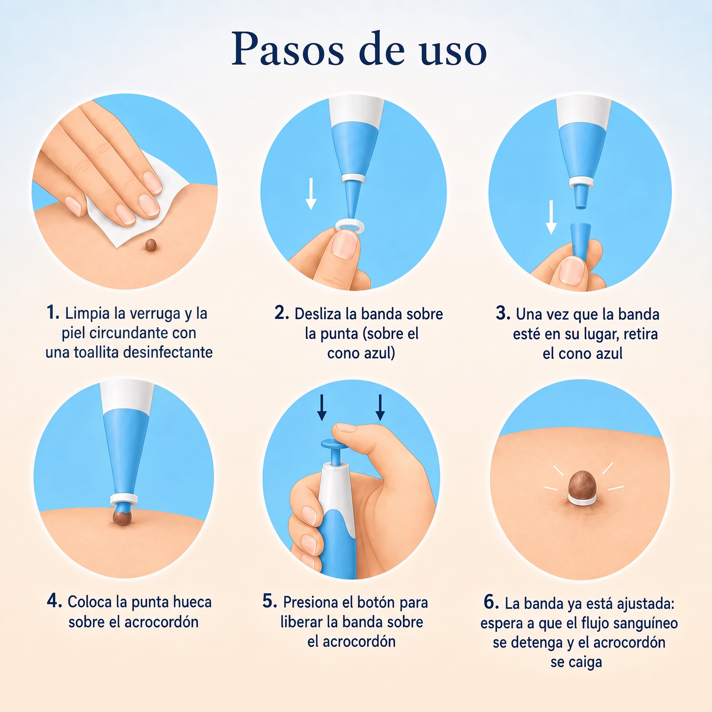 Kit Dervalon™ Removedor de Verrugas y Acrocordones